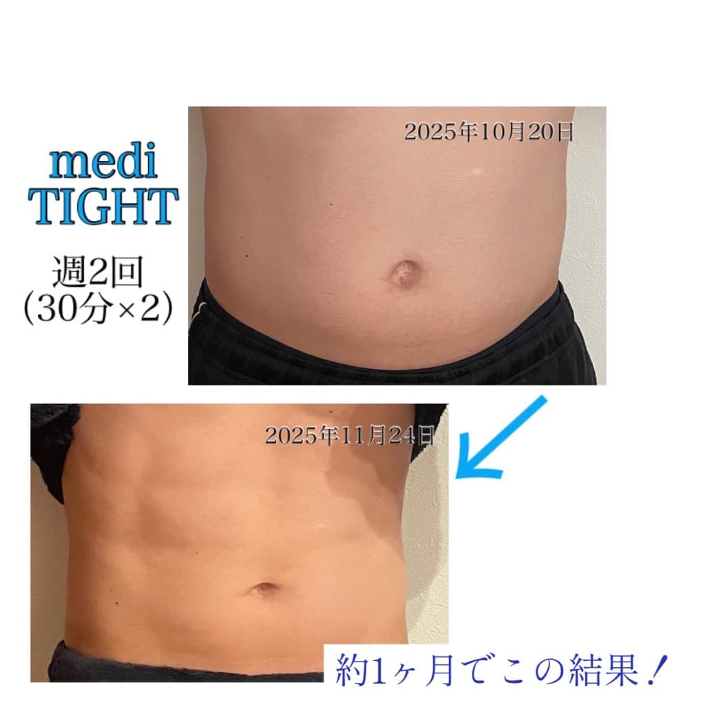 お腹痩せのBeforeとAfter（medi TIGHT・週2回）