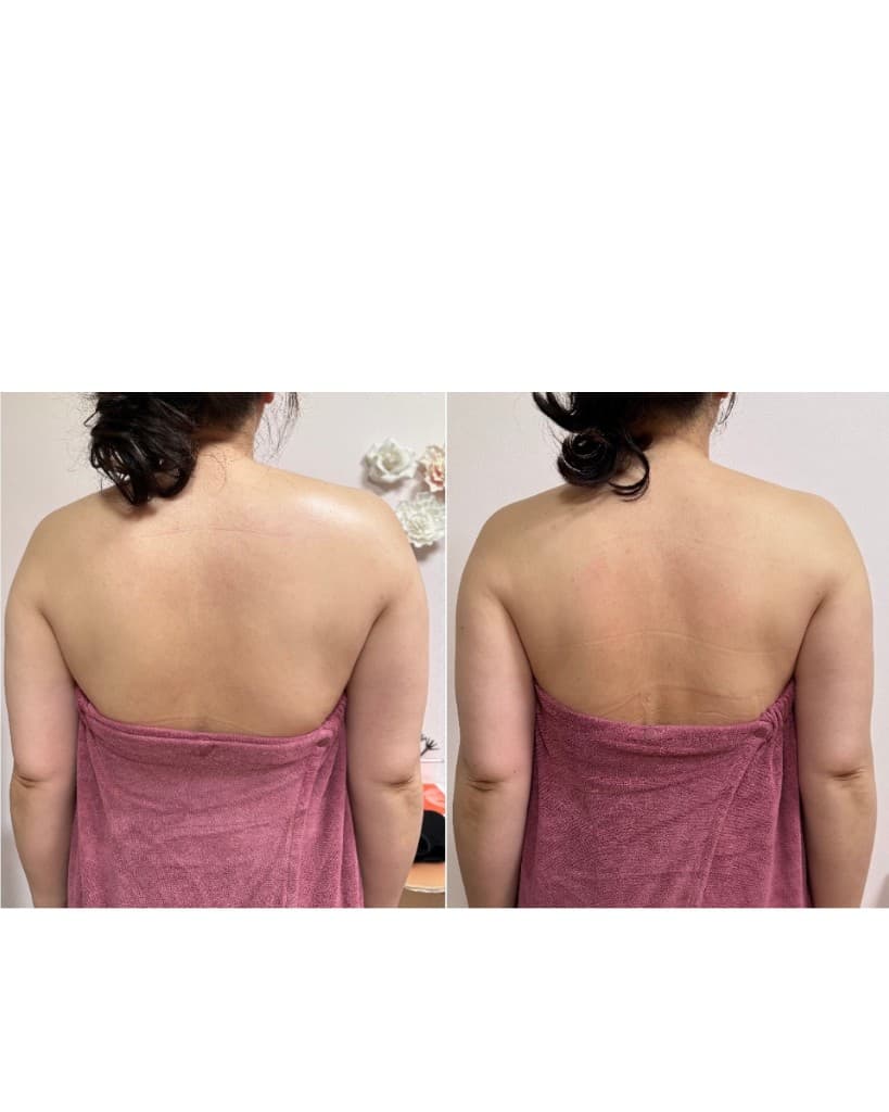 上半身コースのBeforeとAfter（背面・肩・背中）