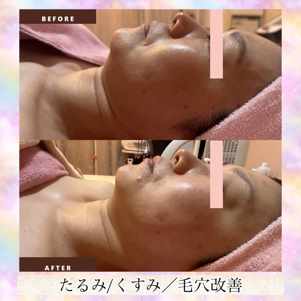 小顔形成リンパマッサージのBeforeとAfter（横顔・たるみ・くすみ・毛穴）