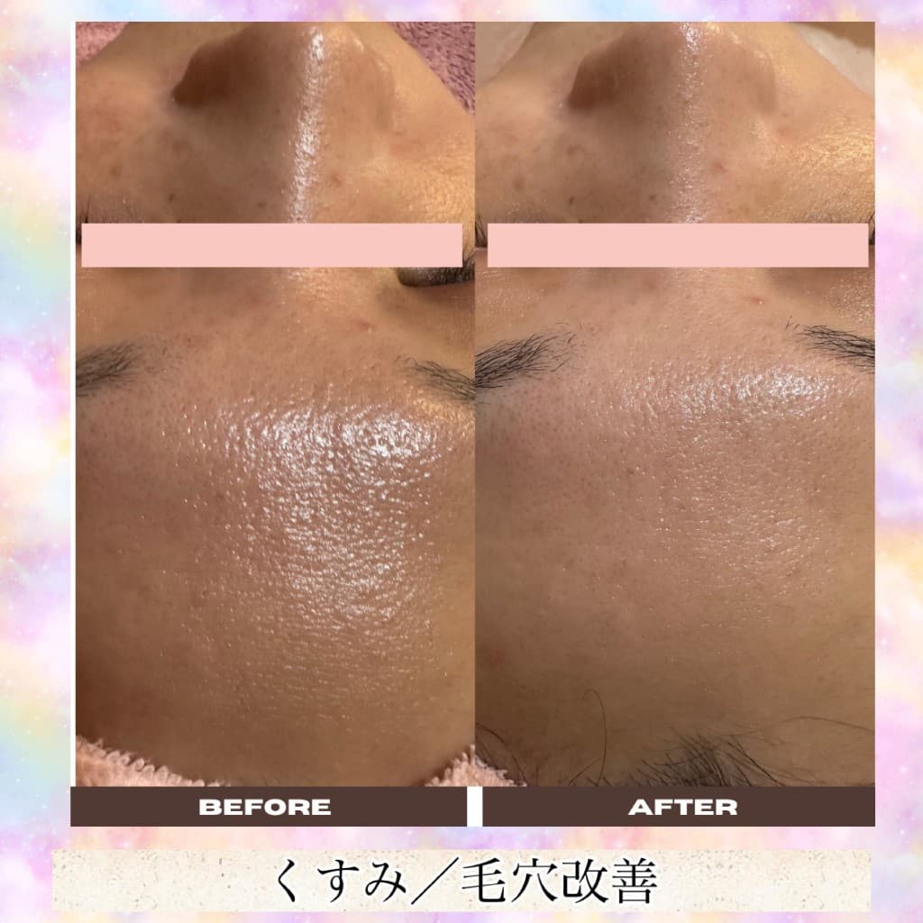 毛穴洗浄のBeforeとAfter（額・くすみ・毛穴）