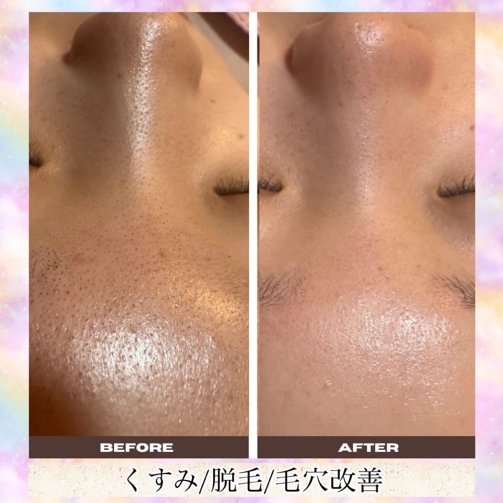 毛穴洗浄のBeforeとAfter（鼻・額・産毛・毛穴）