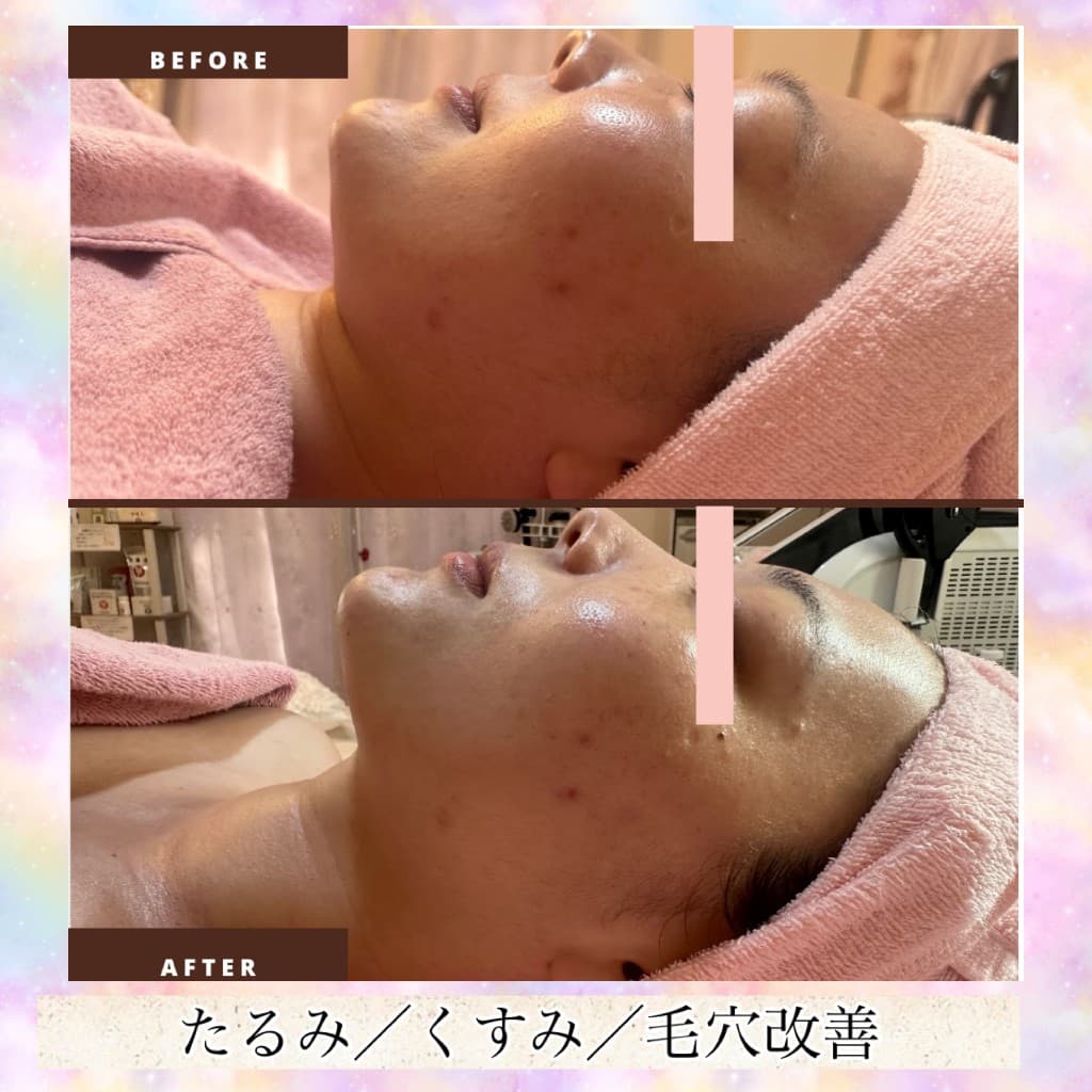 プレミアムコースのBeforeとAfter（横顔・たるみ・くすみ・毛穴）