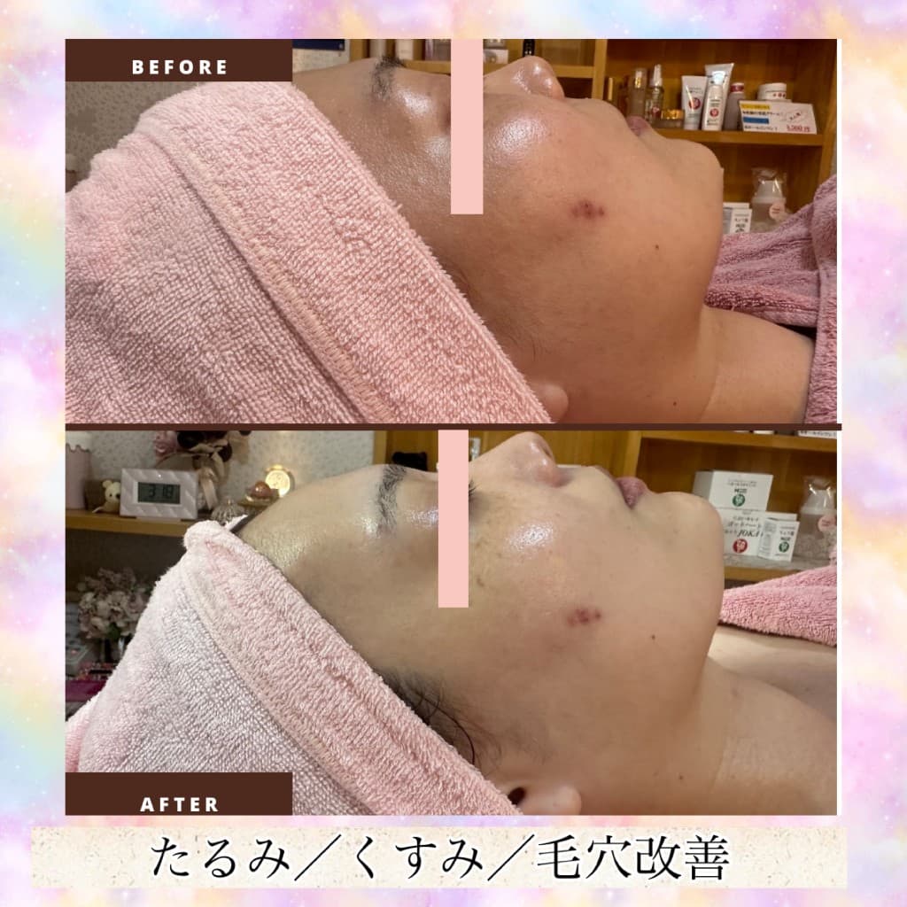 プレミアムコースのBeforeとAfter（横顔・フェイスライン）