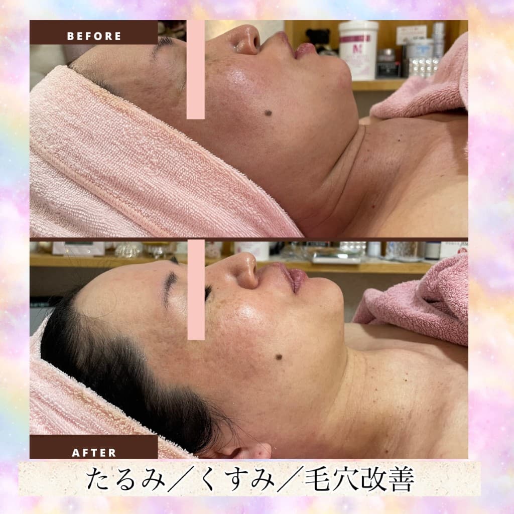 プレミアムコースのBeforeとAfter（横顔・たるみ・くすみ・毛穴）