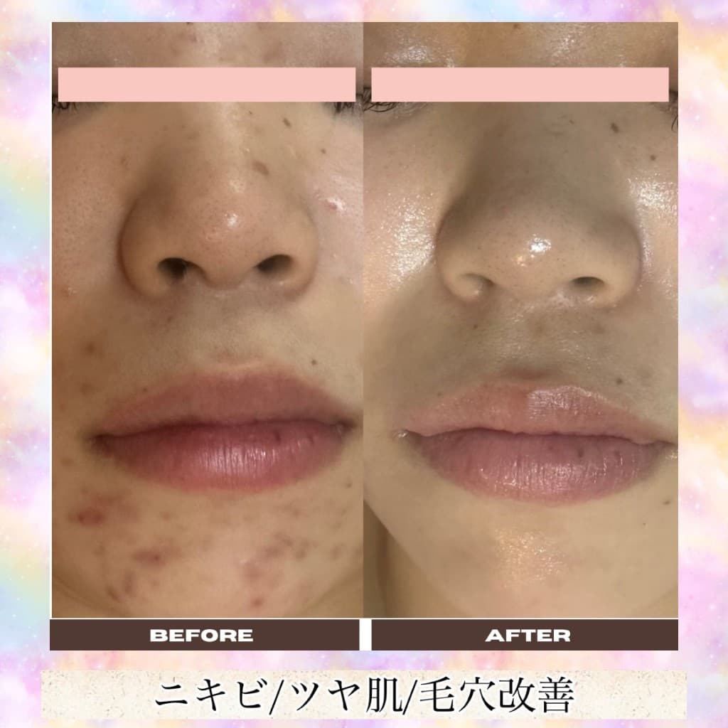 肌質改善のBeforeとAfter（口元・ニキビ・ツヤ肌・毛穴）