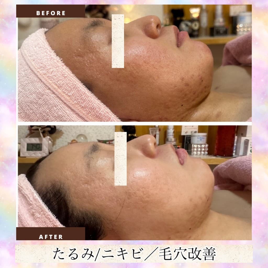 肌質改善のBeforeとAfter（横顔・たるみ・ニキビ・毛穴）